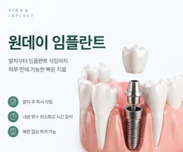 원데이 임플란트