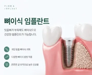 뼈이식 임플란트